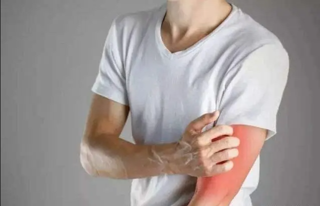 甲醛超标引起皮肤过敏